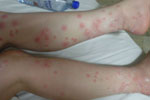 Safe Way to Eliminate Bed Bugs with Natural Bed Bug Formula Guaranteed Effective for Sarasota, FL